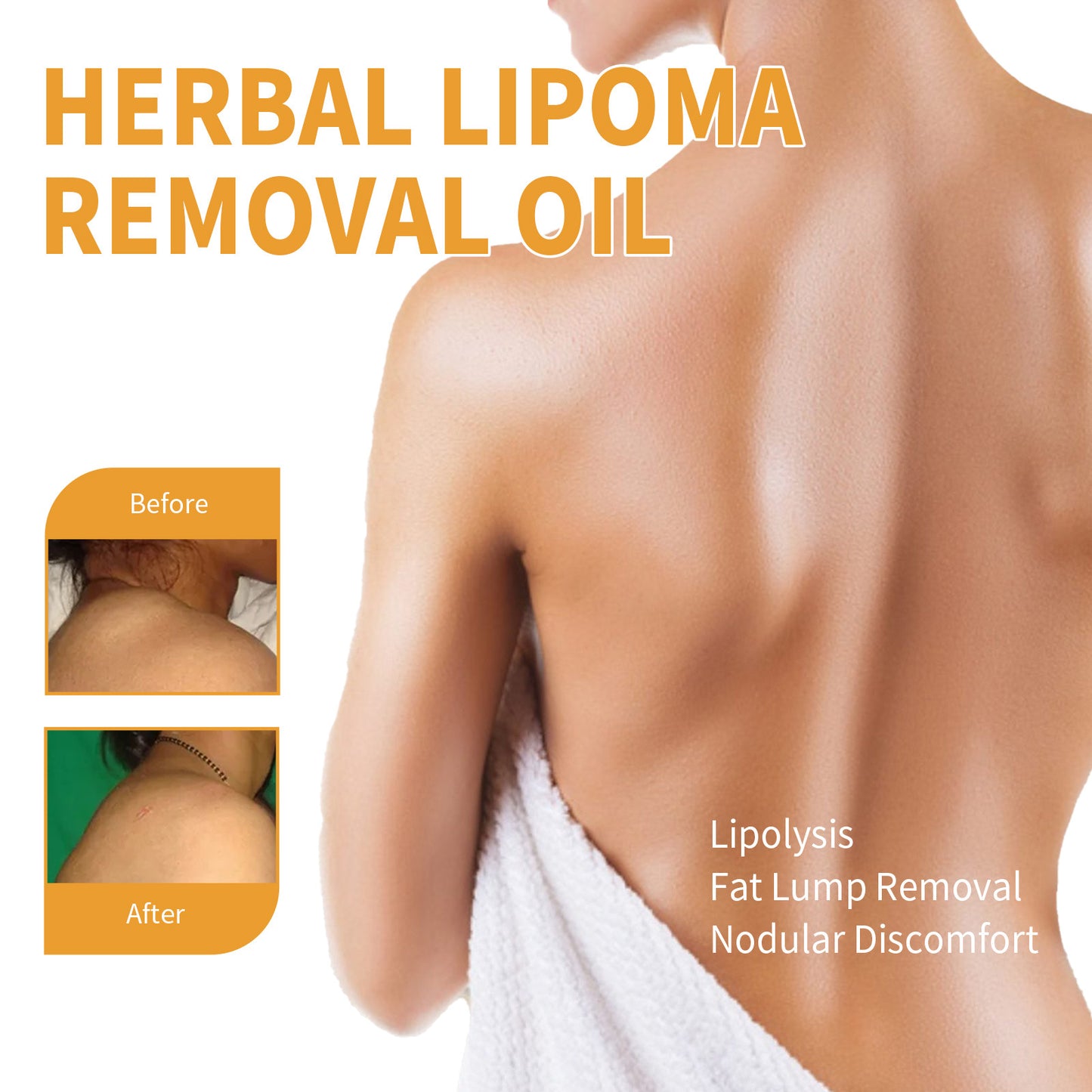Lipoma Removal Oil Lipoma Treatment Herbal Oil
