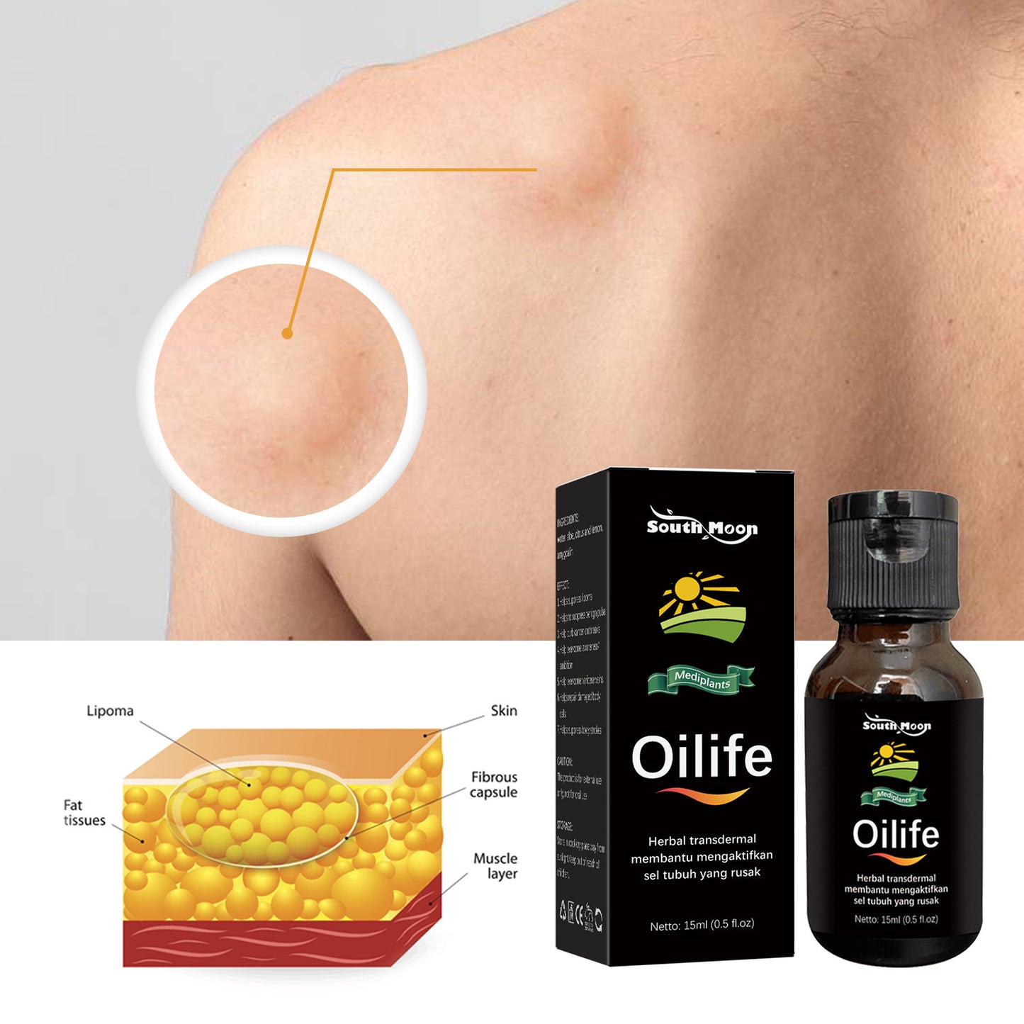 Lipoma Removal Oil Lipoma Treatment Herbal Oil